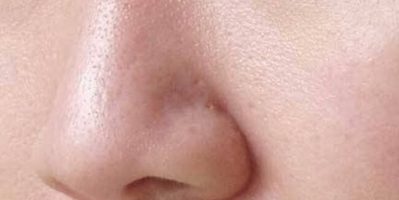 Chăm sóc da đúng chuẩn để thu nhỏ lỗ chân lông