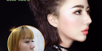 MŨI CAO TỰ NHIÊN THANH TÚ VỚI PHƯƠNG PHÁP NÂNG MŨI BỌC SỤN