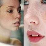 Những điều cấm kị trong quá trình điều trị nám da bạn phải biết