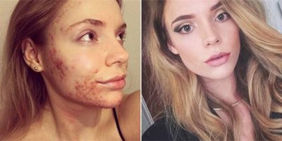 Hãy kiêng 4 nhóm thực phẩm này để xóa tan nỗi lo về mụn