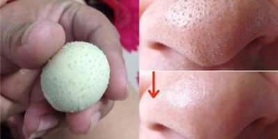 3 Cách Trị Mụn Đầu Đen Tận Gốc Bằng Nguyên Liệu Dễ Tìm