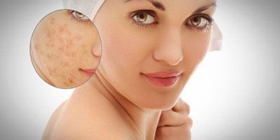 Chúng ta nên chăm dưỡng thế nào và ăn gì để trị sẹo lõm nhanh, hiệu quả nhất?