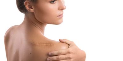 Top kem trị sẹo chính hãng tốt nhất hiện nay