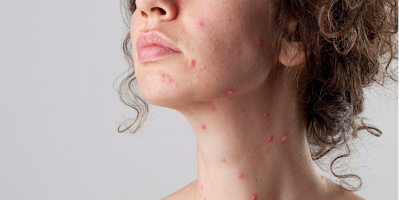 3 Cách Trị Sẹo Thủy Đậu Hết Nhanh Chóng Và Đảm Bảo An Toàn