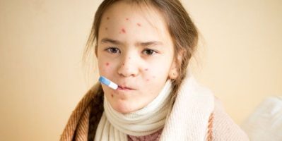 Giải đáp thắc mắc người bị thủy đậu kiêng ăn gì để hạn chế sẹo lõm