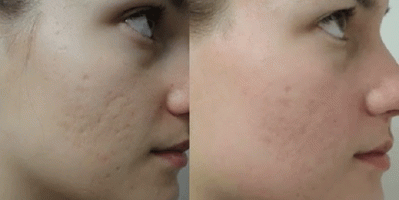 “Học lỏm” 5 cách làm mờ sẹo lõm đã được “hội chị em” công nhận