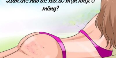 5 Cách Trị Mụn Nhọt Ở Mông Từ Nguyên Liệu Có Sẵn Trong Bếp