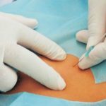 Cấy chỉ có an toàn không