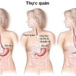 Một số dấu hiệu cảnh báo ung thư thực quản