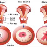 Ung thư cổ tử cung giai đoạn đầu có biểu hiện như thế nào ?