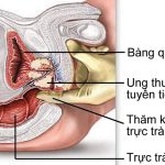 Tầm soát ung thư tuyến tiền liệt như thế nào?