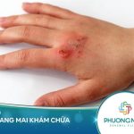 Bệnh giang mai là bệnh gì? có thể điều trị được không?
