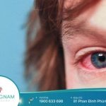 Chia sẻ của chuyên gia phòng khám mắt ở Lâm Đồng