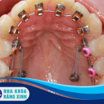 Niềng răng mặt trong có hiệu quả không ?