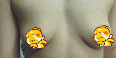 Ngực bị chảy xệ phải làm sao khắc phục? Tamsudaokeo