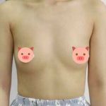 Phẫu thuật nội soi đặt túi ngực ở đâu uy tín