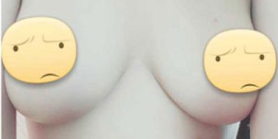 Nâng ngực chảy xệ không cần phẫu thuật – Tamsudaokeo