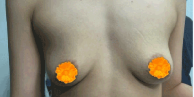 Nâng ngực chảy xệ có đau không? Tamsudaokeo