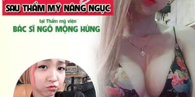 Nâng ngực nội soi hết bao nhiêu tiền thế