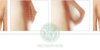 Có ai nâng ngực nội soi chưa các baby