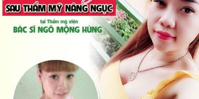 Có nên nâng ngực nội soi không phái đẹp