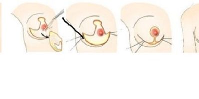 Cách chữa ngực chảy xệ sau sinh –  Địa chỉ thực hiện