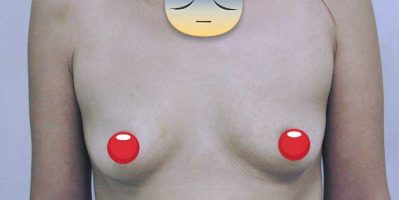 Cách chữa trị ngực chảy xệ sau khi cho con bú – Tamsudaokeo