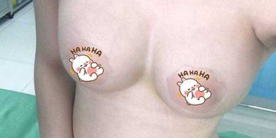 Bật mí phương pháp điều trị ngực chảy xệ – Tamsudaokeo