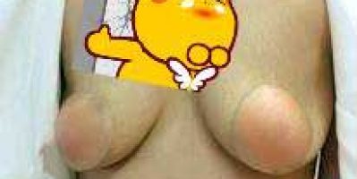 Ngực chảy xệ khi mang thai là như thế nào? Tamsudaokeo