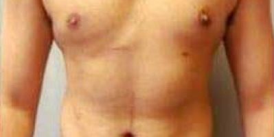 Cách giảm ngực chảy xệ ở nam giới – Tamsudaokeo