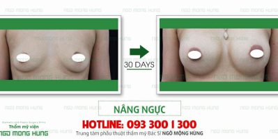 Phẫu thuật nâng ngực bị xệ có ảnh hưởng gì không