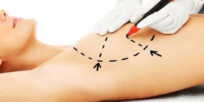 Tìm hiểu về nâng ngực chảy xệ bằng chỉ