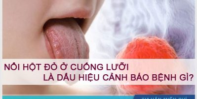 Dấu hiệu cảnh báo khi nổi hột đỏ ở cuống lưỡi