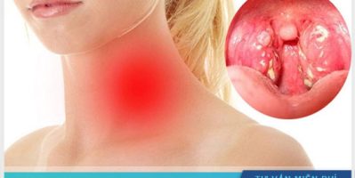 Viêm amidan hốc mủ là gì? có nên cắt không?