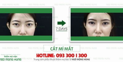Giải đáp thắc mắc cắt mí mắt hết bao nhiêu tiền