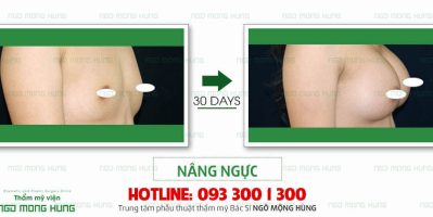 Nâng ngực không phẫu thuật webtretho có bị biến chứng không