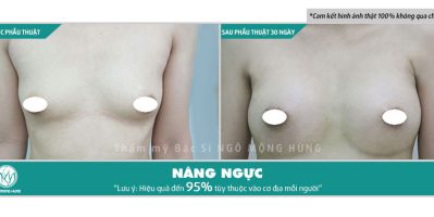 Hình ảnh nâng ngực túi giọt nước sau phẫu thuật