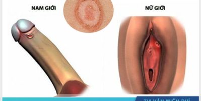 Các có biết các phương pháp xét nghiệm giang mai?