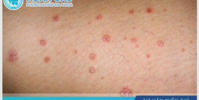 Bạn có biết về xét nghiệm SYPHILIS không ?