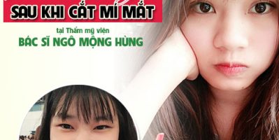 Diễn đàn cắt mí mắt – Hội chị em chia sẻ kinh nghiệm