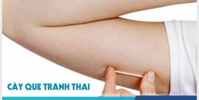 Ưu nhược điểm của đặt Vòng Tránh Thai ở tay