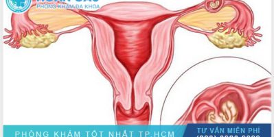 Viêm phận phụ ở nữ giới rất nguy hiểm đừng xem thường