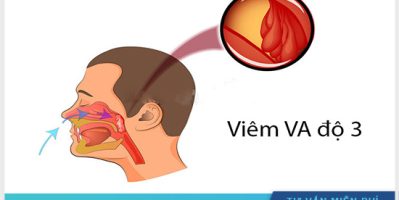 Viêm VA độ 3 là gì? Có nguy hiểm không ?