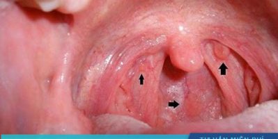 Đốt viêm họng hạt như thế nào ? Hết bao nhiêu tiền ?