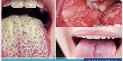 Nấm miệng là bệnh gì ? Nguyên nhân và cách điều trị