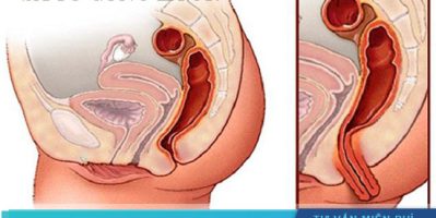 Hiện tượng sa tử cung sau sinh và cách khắc phục