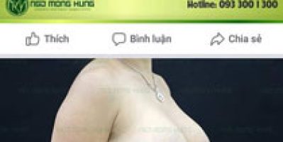 Hình ảnh ngực chảy xệ biến đổi sau phẫu thuật