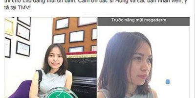 Nâng mũi ở đâu đẹp và an toàn, bảo hành trọn đời