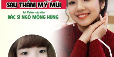 Chi phí phẫu thuật nâng mũi bao nhiêu tiền