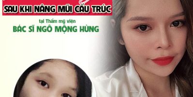 Phẫu thuật nâng mũi giá rẻ nên hay không nên ?